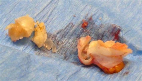 cyst sac coming out.